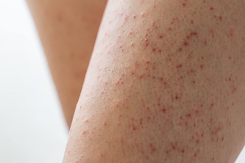effet peau de fraise sur les jambes