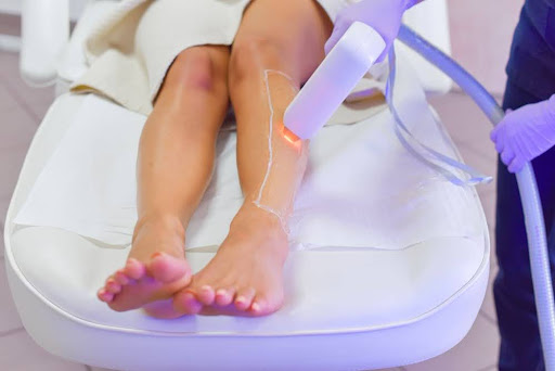 epilation laser sur les jambes d'une jeune femme