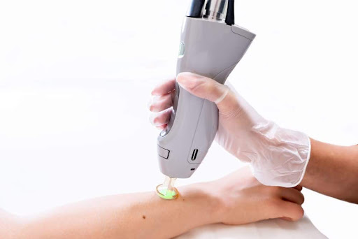 epilation laser